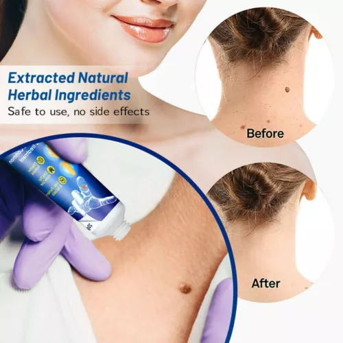 Warzen Entfernung Haut Tag Behandlung Creme Wart Remover Warze Entferner - Bild 9 von 21