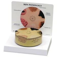Skin Cancer Anatomical Model GPI LFA 3850