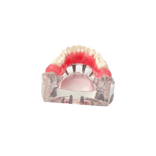 Multiple Types Dental Teeth Model Ortho Implant Practice Teaching Demo Model - Picture 251 of 276