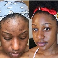 Herbal Power Peel Revolutionary Potent Green Herbal Algae Acne Exfoliating Soap