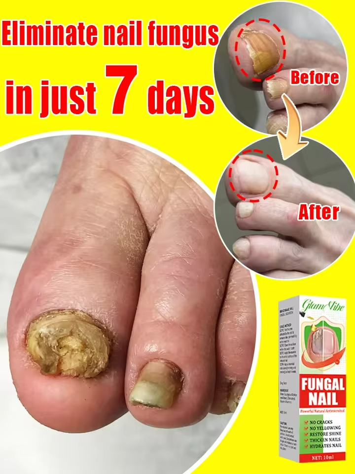 Anti Fungal Nail Treatment for Onychomycosis - Nail Recovery Aid  