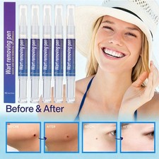 5 5ml Warts Removal Pen Eliminate Wart Pen Wart Liquid Hand Foot Warts Remove