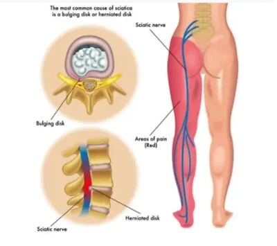 SUNNA SHIFA Sciatica Pain Oil Massage Nerve Muscle Relief Spasms Fibre Natural Treatment