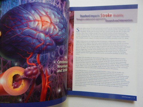 Stanford Neurosurgery Neuroscience Therapies Stem Cells Memory Brain Tumor - Picture 5 of 10