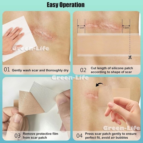 Silicone Scar Sheets & Tape Roll 1.5/3/5M | Scar Removal, Keloid, Acne, Marks - Picture 11 of 20