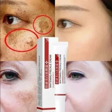 Powerful Spot-removing Whiten Cream Pigmentation Melasma Dark Spots