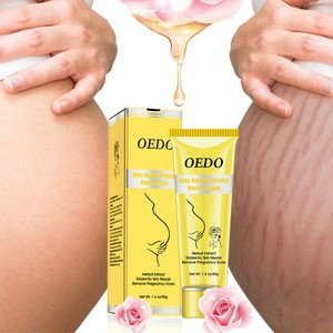 fat stretch marks removal cream