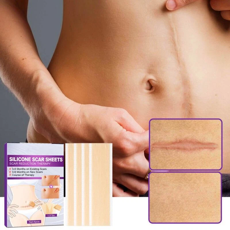 Where can i buy silicone sheets for scars new arrivals