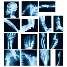 15 Pcs Broken Bones X Ray Set Human X Rays Black and Blue Skeleton Pretend Xrays