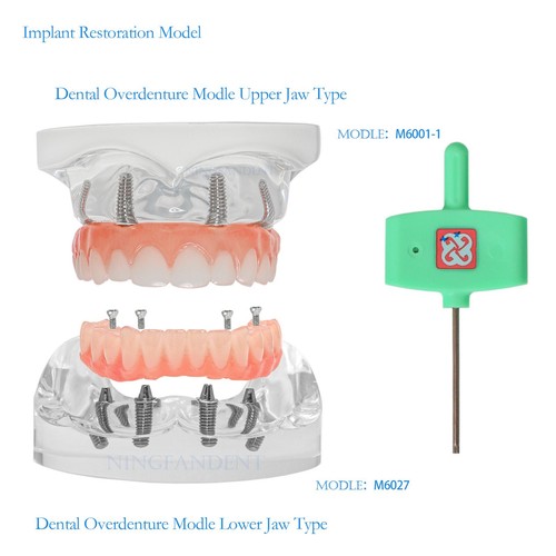 Modelo de implante dental, mandíbula superior inferior, dentaduras RPD, tipos de restauración de sobredentaduras - Imagen 10 de 154