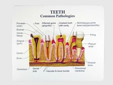 Dental Demonstration Teeth Educational Model Teeth common Pathologies #3339
