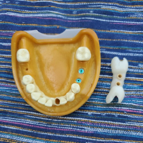 Dental Lower Demonstration Study Model w2 Impants healing collar
