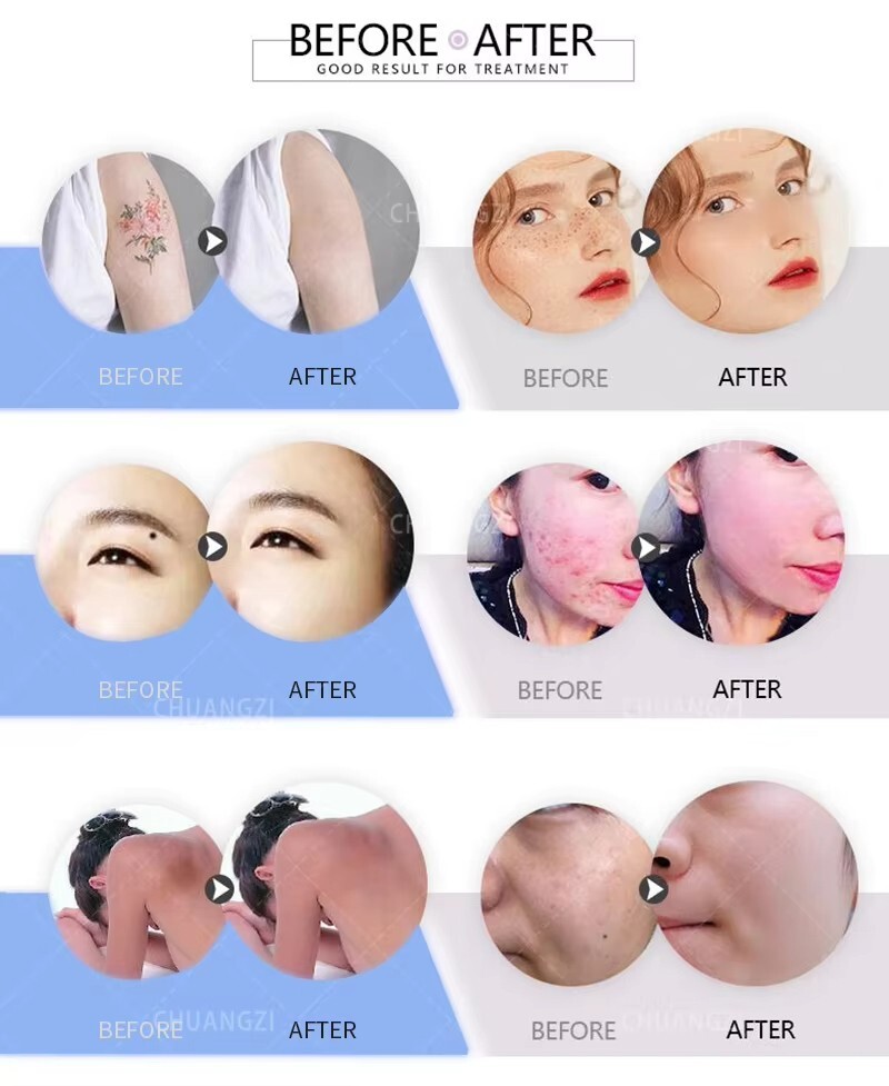 2025 Picosecond Q-Switch ND Yag Laser Machine Pico Laser Tattoo Removal Machine