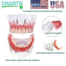Dental Implant Teeth Model Overdenture Restoration Model 4 Implants Upper Lower