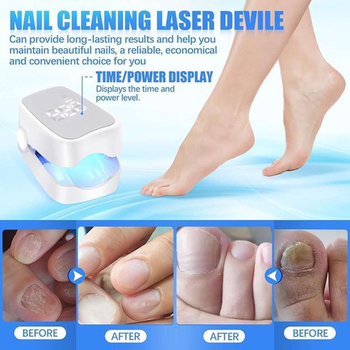 Nail Therapie Lasergerät Fungus Lazer Laser Nagelpilz Fungal für Heimgebrauch - Bild 4 von 7
