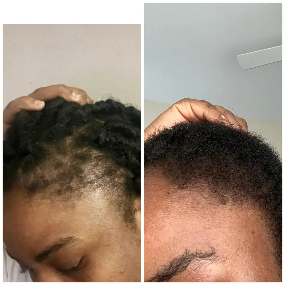 Organic Hair Growth Oil- Alopecia Treatment , Rosemary Infused with Herbs, - Image 3 of 4