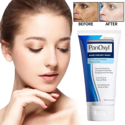 Acne Foaming Wash Face & Body 10% Active ingredient 156g New UK Moisture