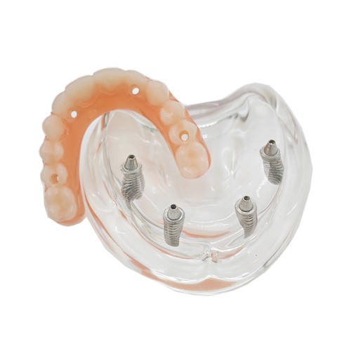Multiple Types Dental Teeth Model Ortho Implant Practice Teaching Demo Model - Picture 269 of 276