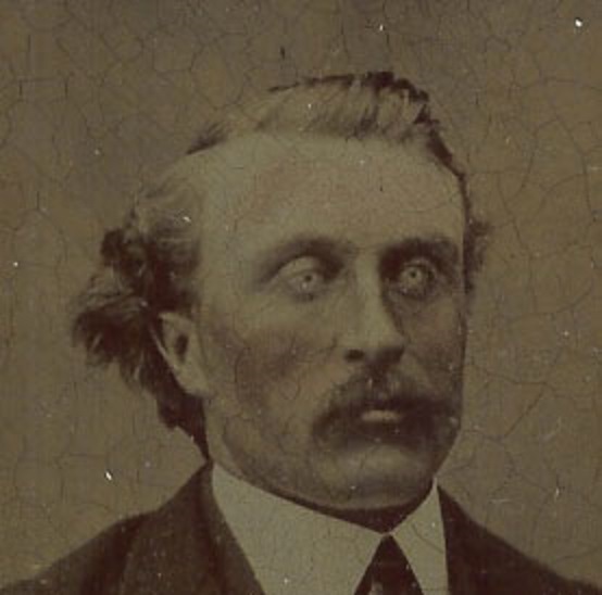 A rare original tintype photograph of a man with a striking medical eye condition — a one-of-a-kind piece of 19th-century photographic history.