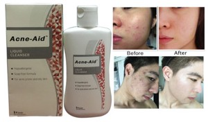 acne aid 100ml