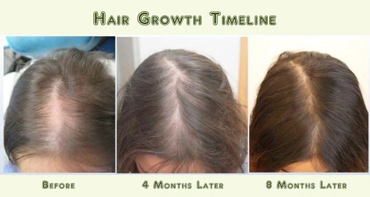 El mejor kit de tratamiento para el crecimiento de la prevención del adelgazamiento de la pérdida del cabello para hombres mujeres aceites orgánicos Foto 2 de 4