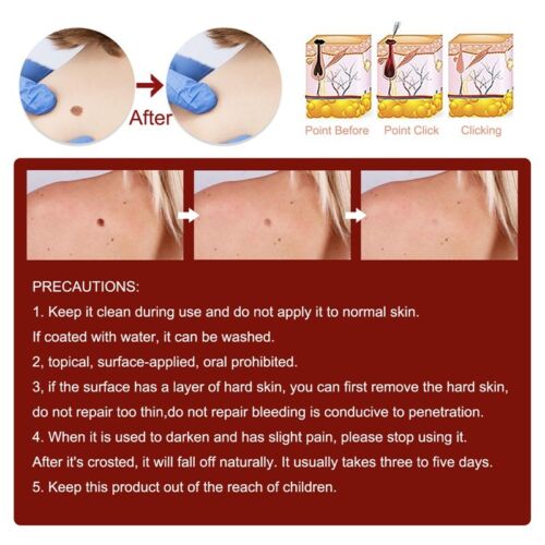2X Common and Plantar Moles-Off Wartsoff Entferner, Abwischen Etiketten & Moles Entferner USA - Bild 9 von 16