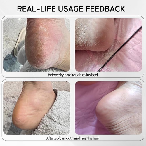 Rechargeable Metal Electric Foot File Callus Remover, Grinder Tool for Feet D... - Picture 6 of 7