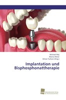 Implantation Und Bisphosphonattherapie Michael Maj (U. A.) Taschenbuch 68 S.