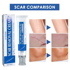 NEW Scar Acne Removal Gel Ointment Stretch Marks Old Scars Burns Repair Cream