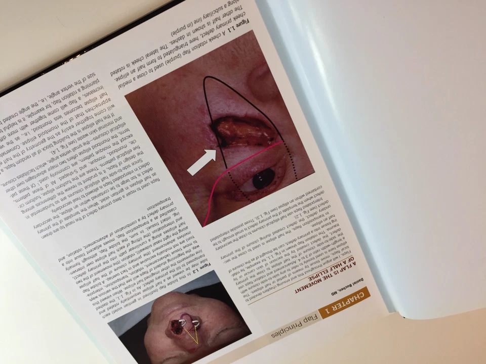 Skin Flaps in Facial Surgery - Image 4 of 4