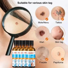 30ml Wart Remover Liquid Skin Tag Remover Eliminate Feet Corn Flat Wart Remove