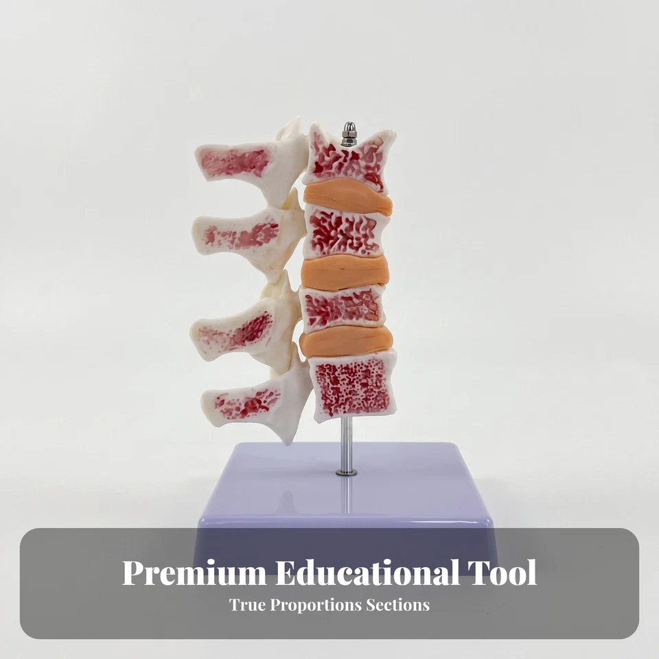 Modèle D'ostéoporose de la Colonne Médical pour Laboratoire, Enseignants - Photo 3/4