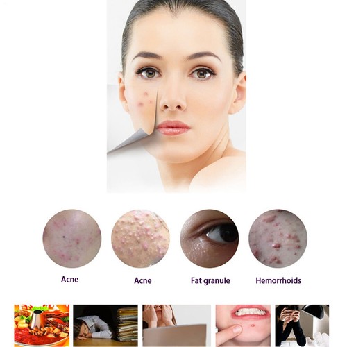 Besenreiser Radierer Blaulichttherapie Falten Akne Laser Entfernung Stift Wiederaufladbar - Bild 4 von 12