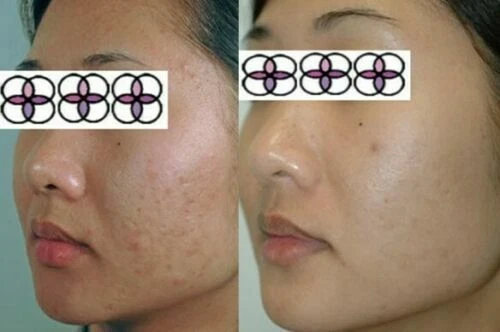 10-20-30-40-50-60-70% Glycolic Acid Night Cream 2oz/ 60ml Aging/Acne/scar - Image 2 of 4