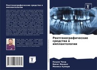 Keshaw Chand (U. A.) | Rentgenograficheskie Sredstwa W Implantologii | Buch