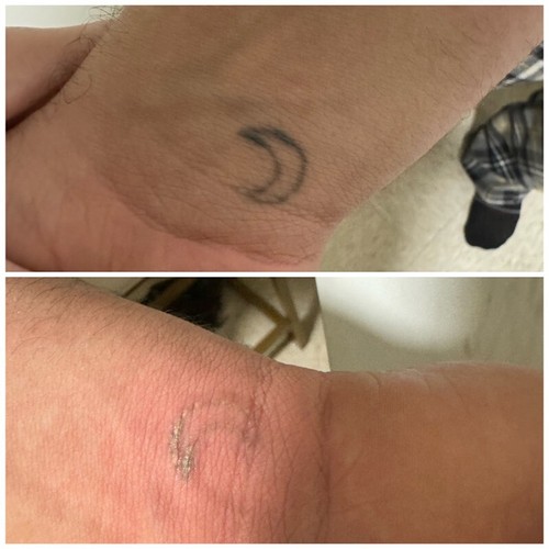 macchina laser nd yag rimozione sopracciglia tatuaggio peeling carbonio rassodamento pelle - Foto 5 di 10
