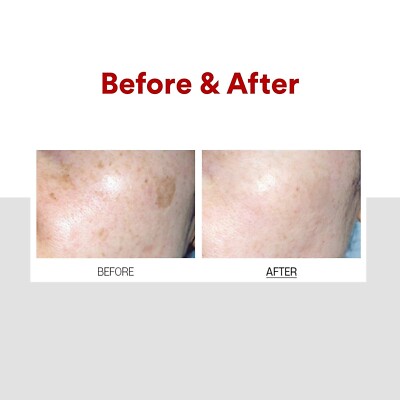 melanotan acne marks harmony_aesthetics  Los Angeles, CA An Illegal Injectable Tanning Drug