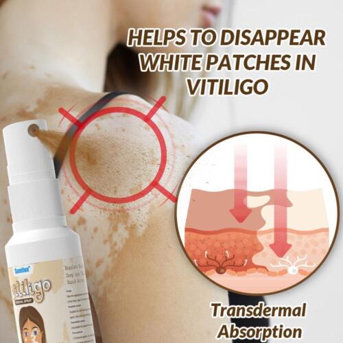 Vitiligo Removal Cream Natural White Spot Treatment Leucoplakia Fast Acting C6Q4 - Picture 18 of 22