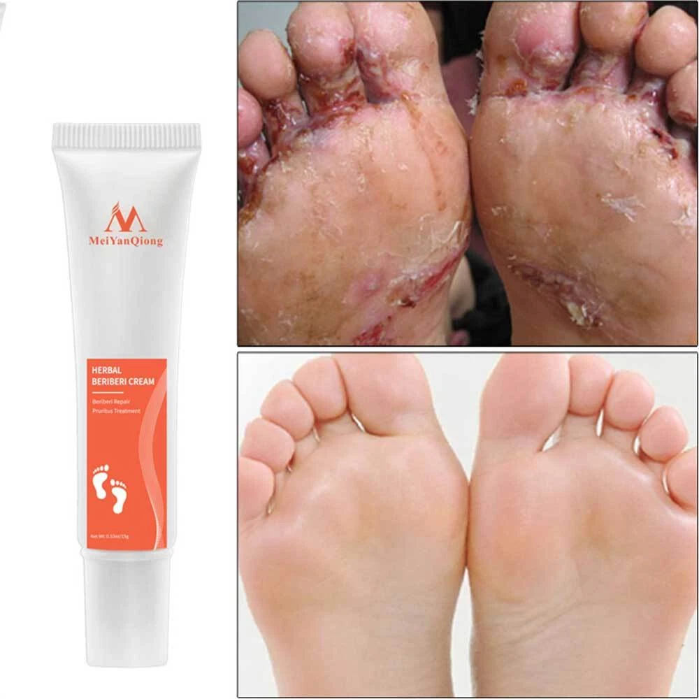 Foot crack deals medicine