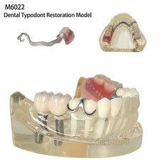 M6022 Dental Implant Typhodont Restoration Teeth Model With Partial Denture