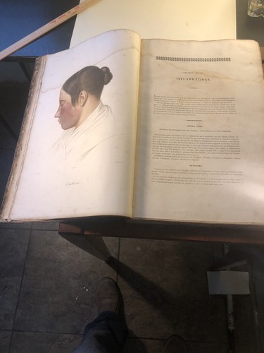 Cazenave Dermatology Book Lecons Sur Les Maladies De La Peau 1856 Elephant Folio - Picture 6 of 12