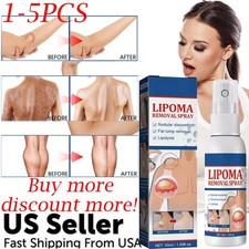 1-5PC Lipomheilung Reduction Spray,Instant LumpFree Lipoma Removal Spray USA Hot