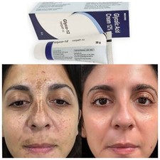 GLYCO 12 Glycolic Acid CREAM 12 Reduce Wrinkles Prevents Acne 30gm Free Shipp