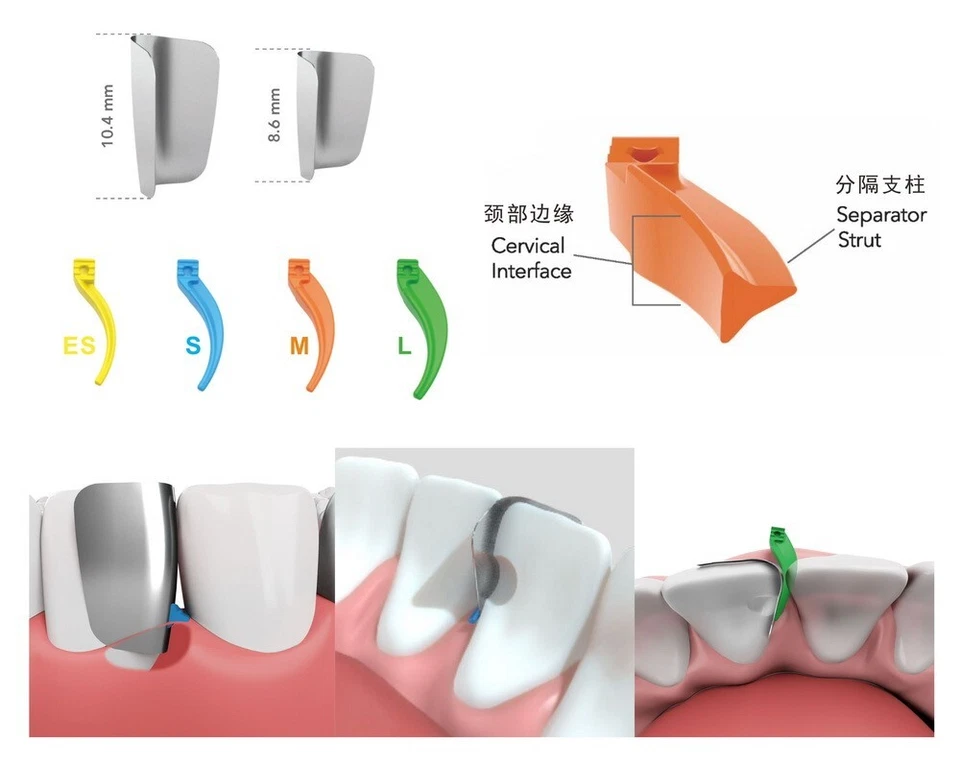 Kit de cuñas de restauración de sello cervical sistema de matriz dental anterior 200 piezas Foto 2 de 4