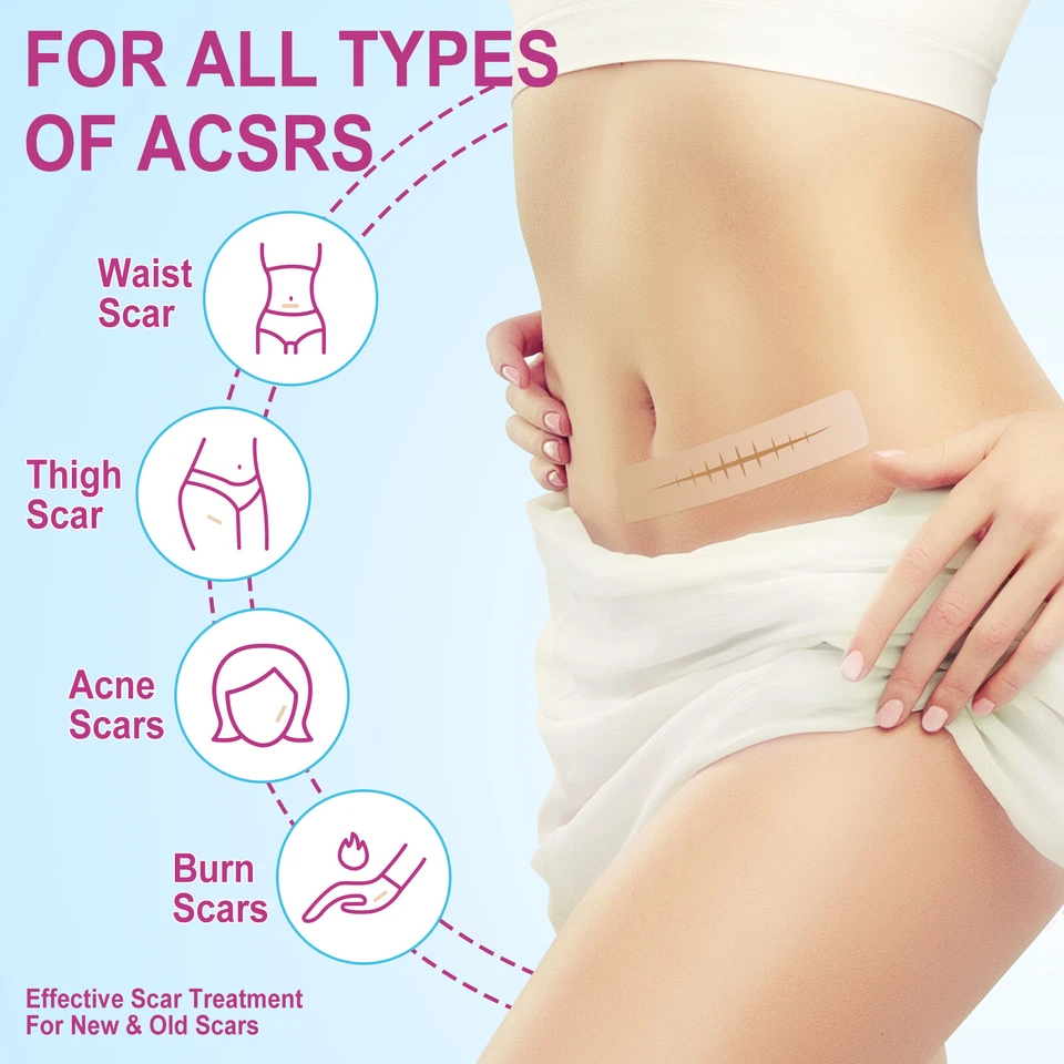 Scar Removal Silicone Tape for Hypertrophic Scars & Keloids, 1.6'' x 75''/150" - Image 4 of 4