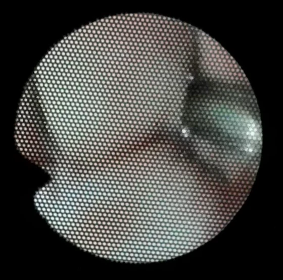 Mira para intubación pediátrica Olympus endoscopia LF-P/imagen nítida y clara Foto 4 de 4