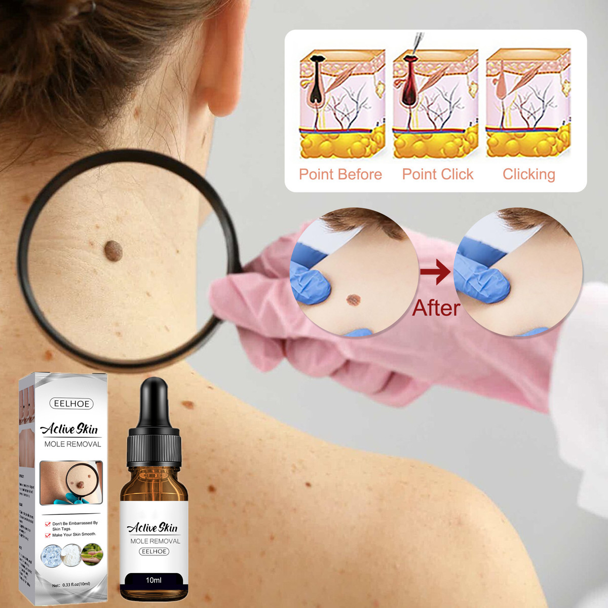 Shark Tank Skin Tag Remover Where To Buy Amazon Skin Tags Removal Products