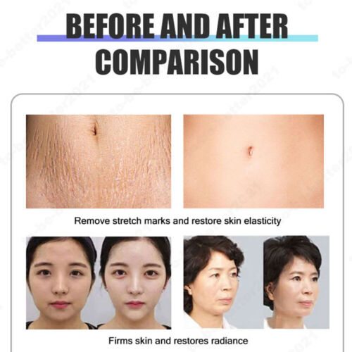 Macchina di bellezza rassodante viso corpo acne cicatrici rimozione rughe RF Mi-cro-needling - Foto 10 di 15