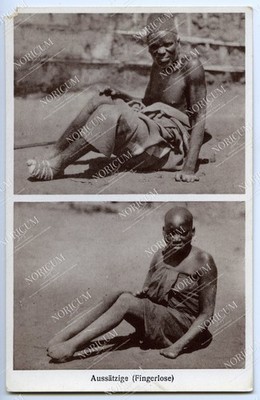 Mehrbild AK - DOA Aussätzige (Fingerlose), Benediktiner Mission Ostafrika #1396