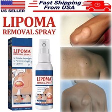 50ML Lipomheilung Reduction Spray, Instant LumpFree Lipoma Removal Spray USA Hot
